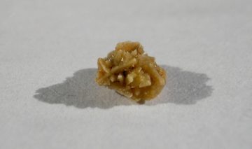 CALCOLI RENALI