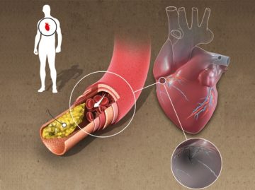 ARTERIOSCLEROSI E DIETETICA