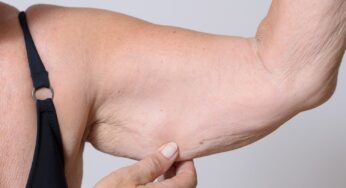 sarcopenia