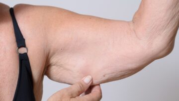 SARCOPENIA UNA MALATTIA CONTRO CUI SI GIOCA ANCHE LA NOSTRA SALUTE